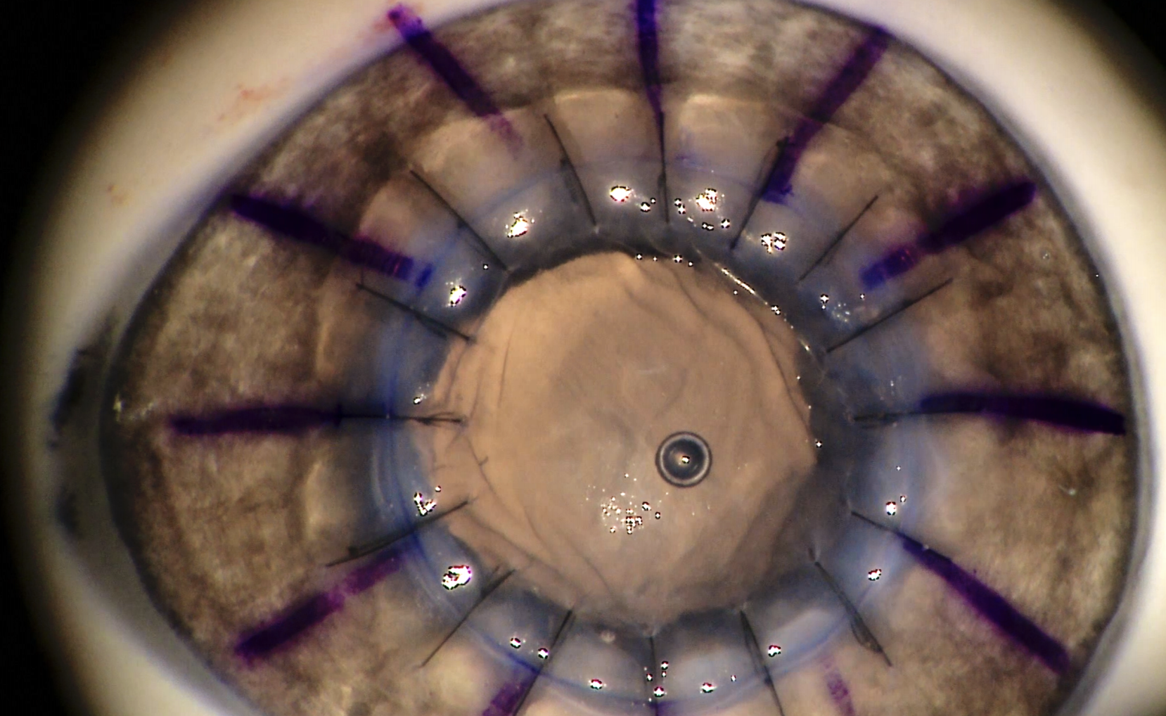 Cirugia de la cornea. Queratoplastia penetrante