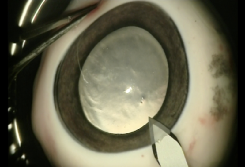 Cirugia de catarata extraccion extracapsular 