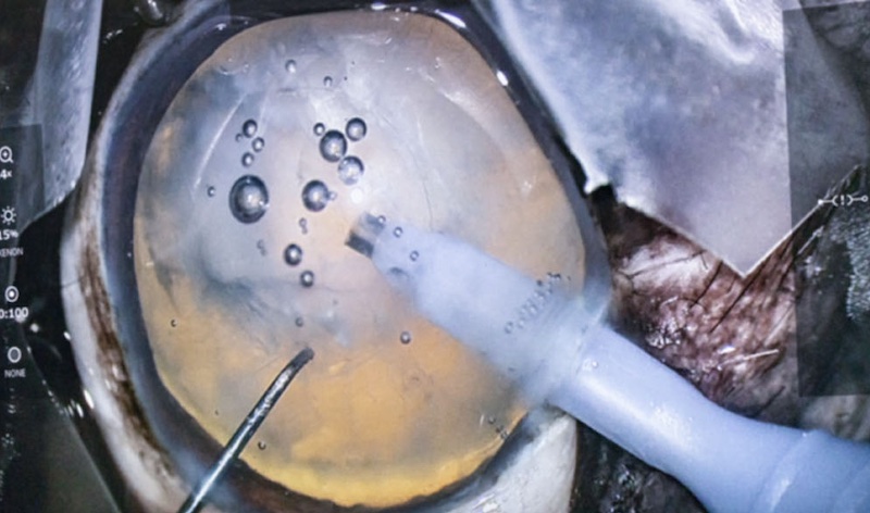 Cirugía de catarata con microscopio Artevo 3D