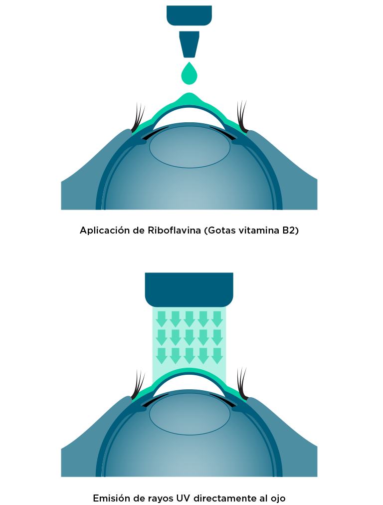 esuema de la técnica de crosslinking corneal