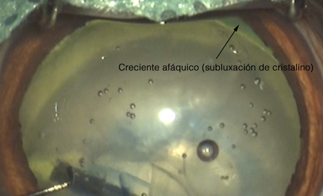 Subluxacion cristalino perro