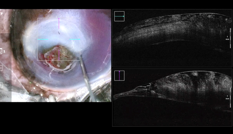 OCT intraquiúrgica o IOCT.