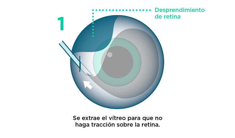 Vitrectomía: procedimiento paso 1