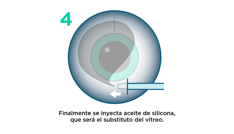 Vitrectomía: procedimiento paso 4