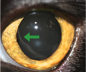 Masa-uveal-quiste-iris