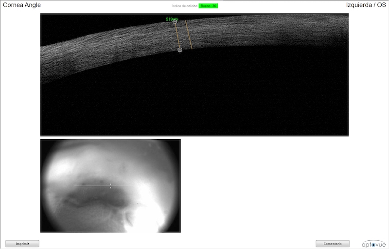 OCT corneal de bulldog francés con úlcera infectada