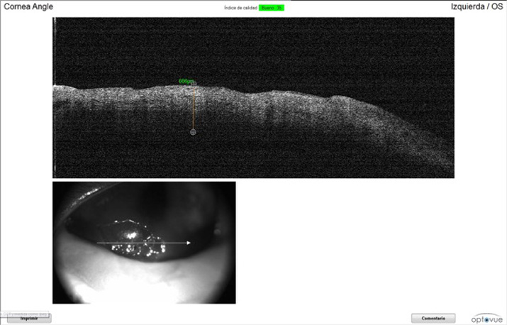 OCT posterior a la queratectomía en gato