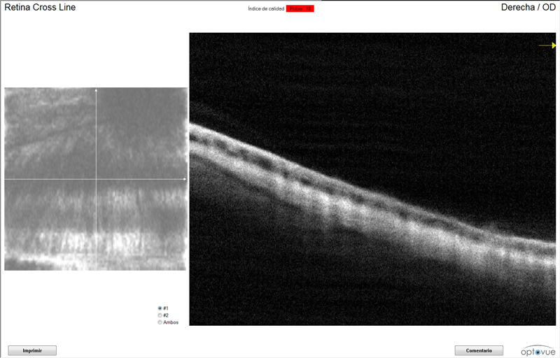 OCT Retina glaucoma Riky