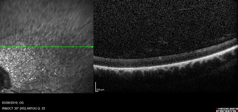 OCT retina glaucoma Riky