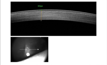 OCT Tomografia Coherencia Óptica - Córnea normal