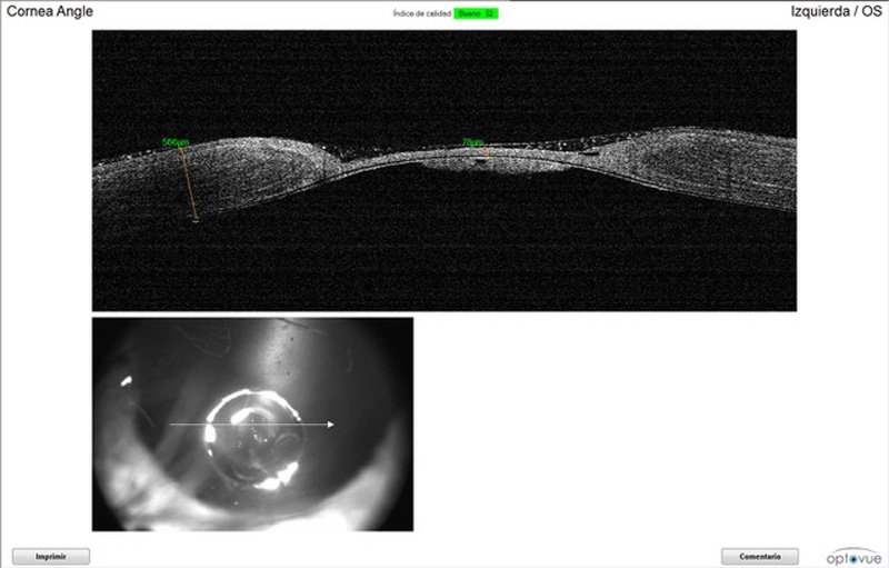 OCT de úlcera profunda