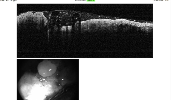 OCT de tumor corneal de perro Bulldog Inglés