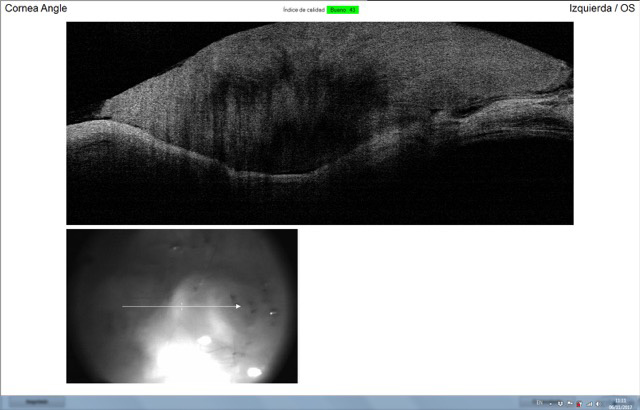 OCT de ojo con perforación corneal post tratamiento quirúrgico con factores de crecimiento PRGF