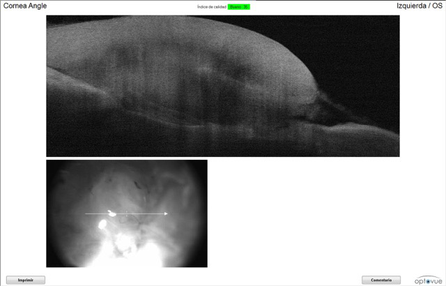 OCT de ojo con perforación corneal post tratamiento quirúrgico con factores de crecimiento PRGF