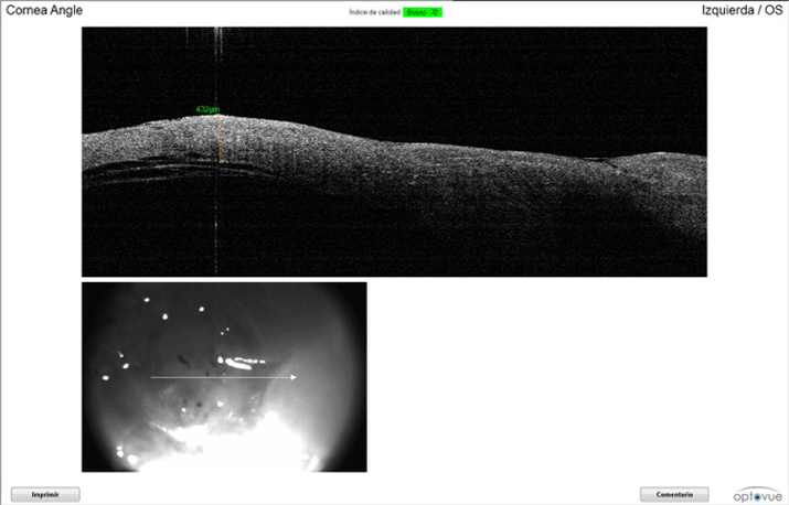 OCT caso perforación ocular revisión