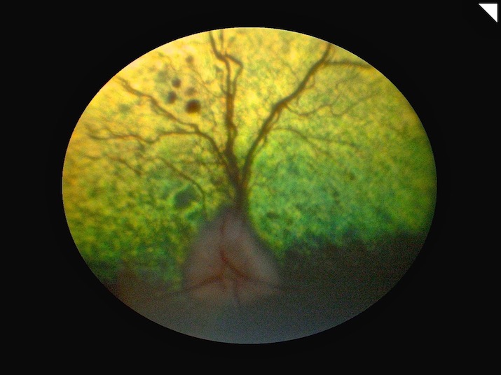 Retinopatia diabética