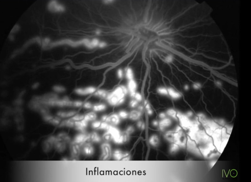 Angiografía fluoresceínica