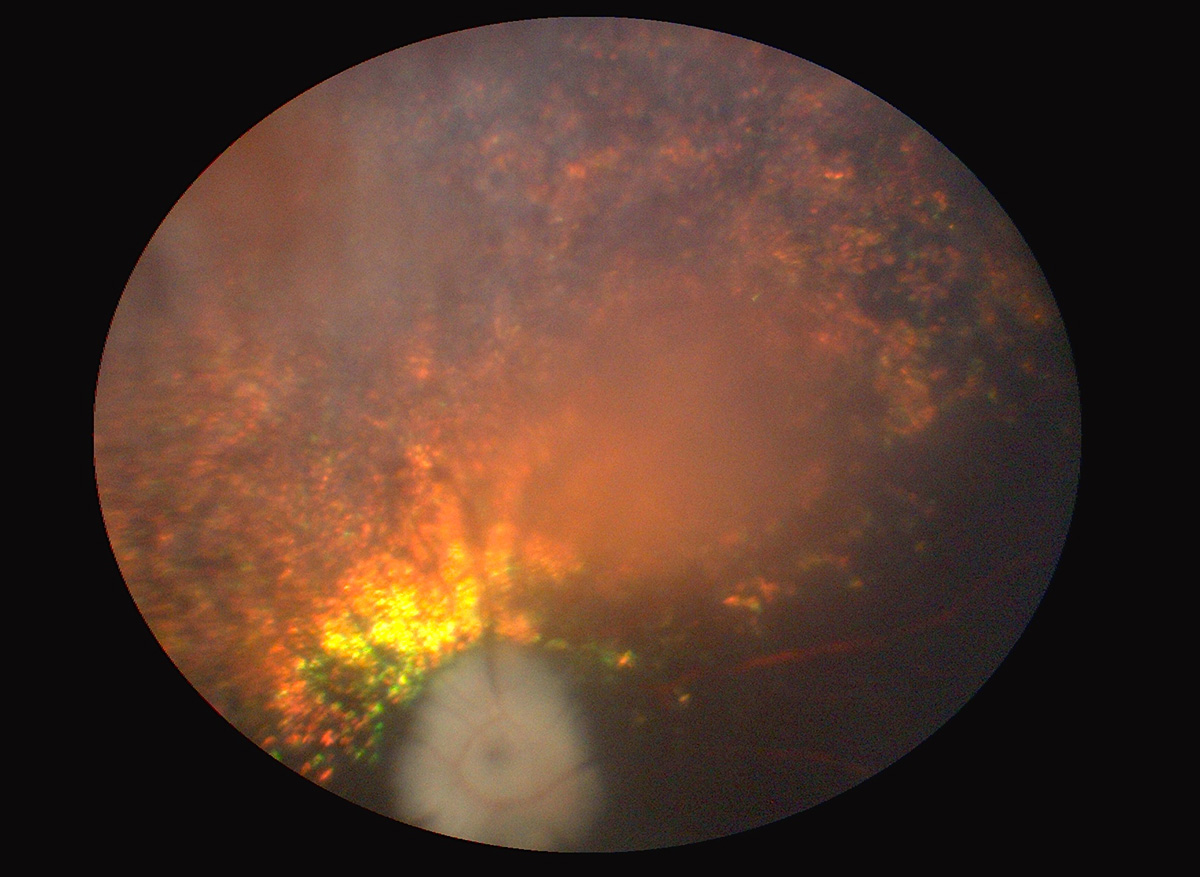 atrofia-progresiva-retina-2