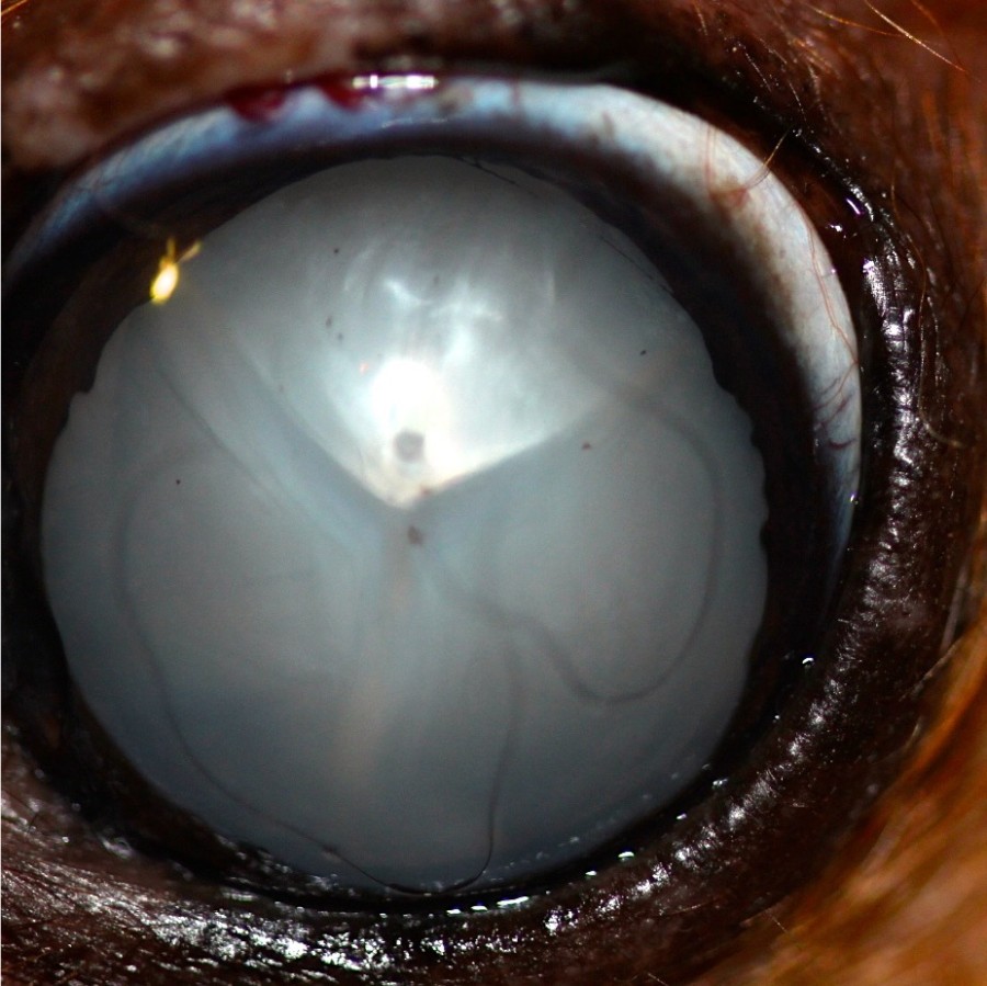 cataratas diabéticas