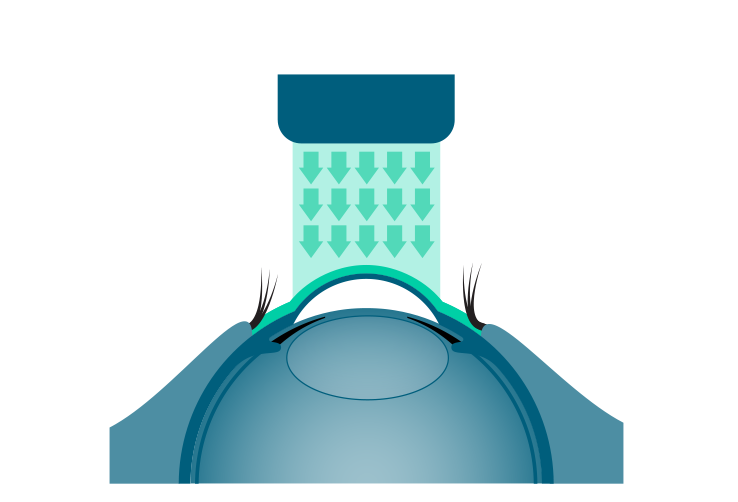 Aplicación de radiación ultravioleta en la técnica de cross-linking corneal