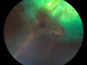 Desprendiimento de retina y hemorragia vítrea en gato a la 1a semana de tratamiento