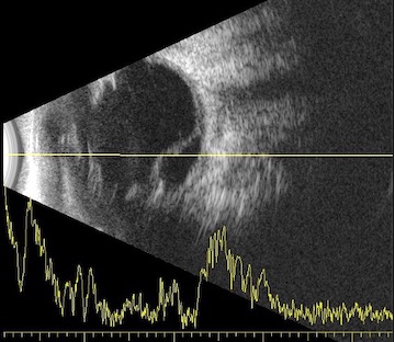 Ecografía ocular gato con desprendimiento de retina