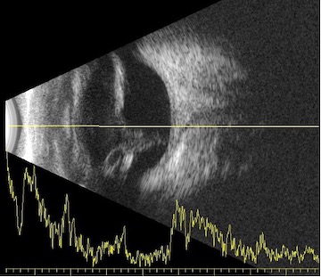 Ecografía ocular gato con desprendimiento de retina