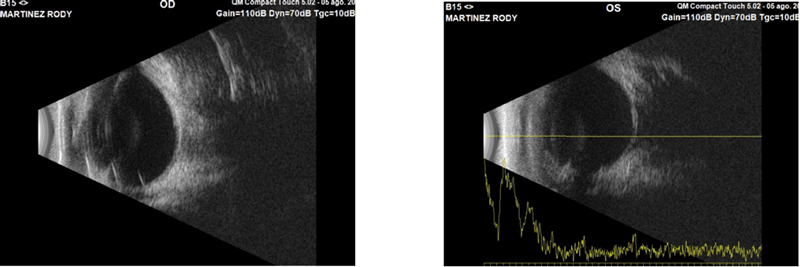 Ecografía ojos perro con uveitis lipémica