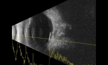 Ecografía perro con desprendimiento de retina - Caso Fox