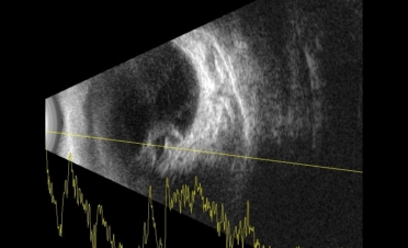 Ecografía perro con desprendimiento de retina - Caso Fox