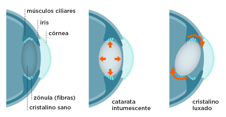 Catarata intumescente y cristalino luzado