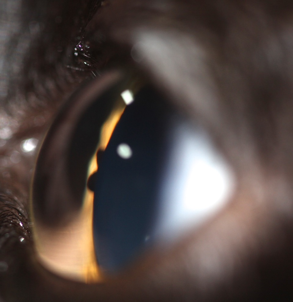 Masa uveal quiste de iris en un gato