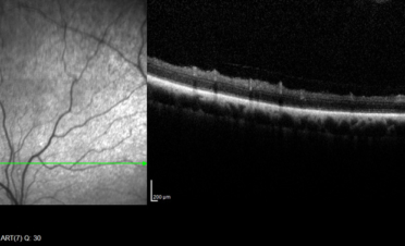 OCT de retina en perro - Caso luxacion cristalino Rio