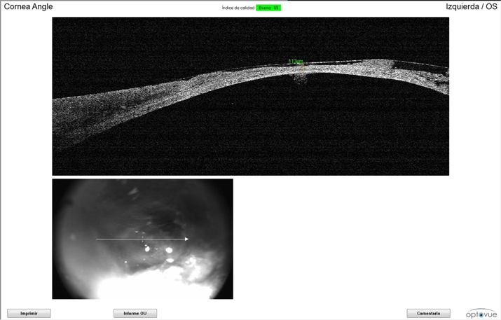 Tomografía coherencia óptica OCT gato úlcera