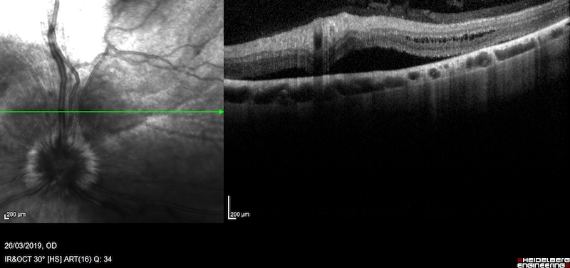 OCT perro con uveítis posterior