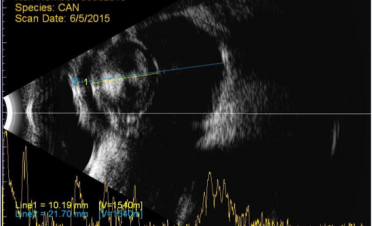 Ecografía ojo normal con catarata
