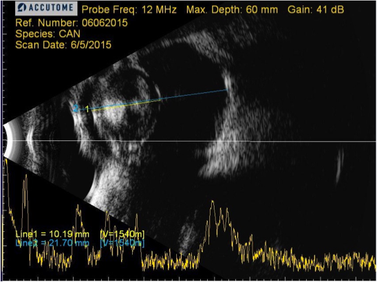 Ecografía ojo normal con catarata