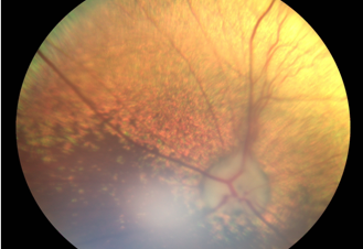 Ojo canino con glaucoma