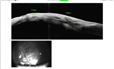 En la OCT de un ojo con perforación corneal se aprecia una falta de continuidad de las capas corneales. Foto: IVO.