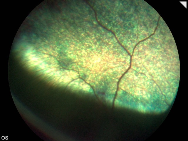 Retinografía post quirúrgica- caso vitrectomía