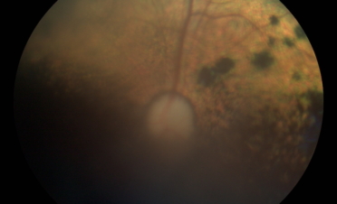 Retinografia perro post vitrectomia por desprendimento de retina - Caso Fox