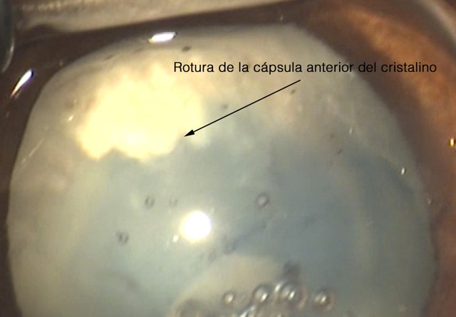 Rotura capsula cristalino