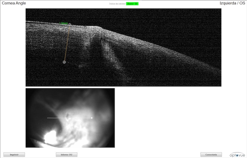 OCT de córnea en que se aprecia trayectoria de cuerpo extraño en el ojo de un perro