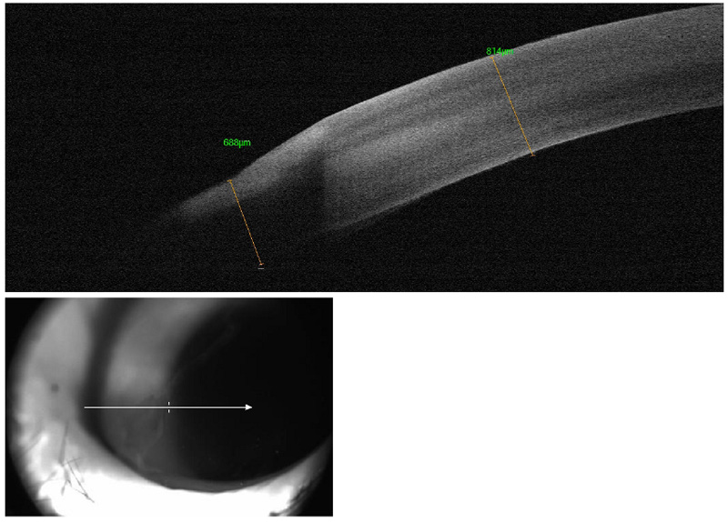 Tomografía de coherencia óptica OCT de un águila americana